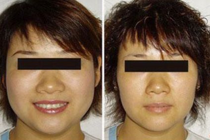 隆鼻手術后的常見問題有哪些