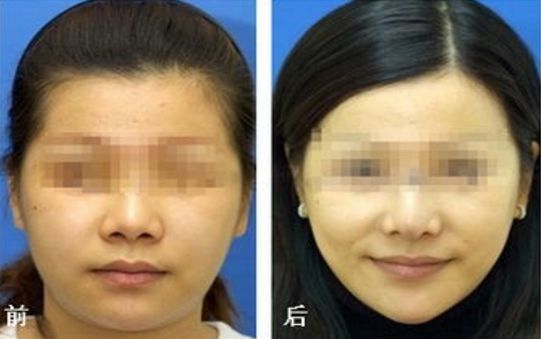 擁有年輕目光可以靠什么？教你選擇適宜去眼袋方法！