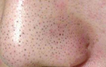 雙眼皮手術失敗后的補救措施及經(jīng)驗分享