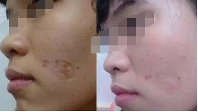 彩光嫩膚維持時(shí)間影響因素總結(jié)