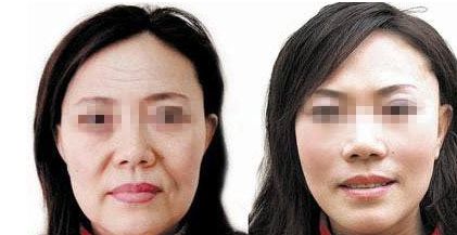 下頜整形常見技術(shù)及優(yōu)缺點(diǎn)解析