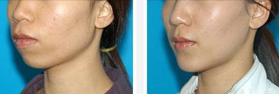 皮膚激光療程的價(jià)格和效果一覽，讓你輕松了解！