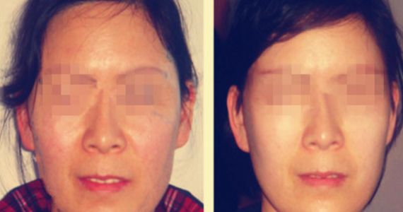 opt光子嫩膚費用及價格查詢詳解，了解opt光子嫩膚真實價格與口碑評價