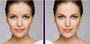 痤瘡如何使用激光緩解？了解一下痤瘡護(hù)理方法吧！