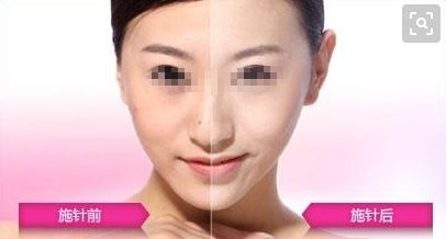 耳朵重塑技術(shù)是否優(yōu)質(zhì)？整形手術(shù)費用如何評估？