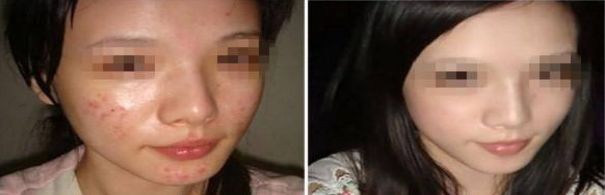 隆鼻術(shù)后一個(gè)月修復(fù)措施有哪些？