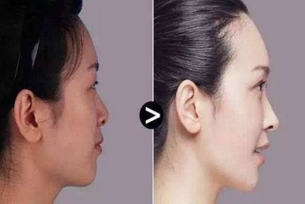 雙眼皮手術(shù)效果如何？割出雙眼皮有什么關(guān)鍵？