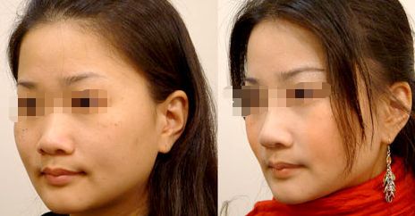 廣州海峽雙眼皮好評如潮，有效突顯雙眼魅力