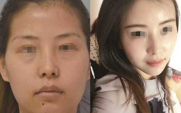 激光脫毛價格、痛感、持續(xù)時間及副作用解析！