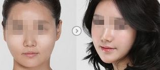 植發(fā)技術(shù)：從禿頂?shù)綕饷茴^發(fā)的奇跡