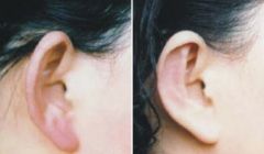 打造挺拔鼻梁，揭秘5種鼻綜合隆鼻技術(shù)！注意事項(xiàng)不可忽視