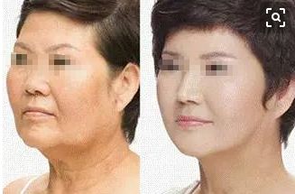 15歲女孩整容成果驚人！爸媽都認(rèn)不出來(lái)了