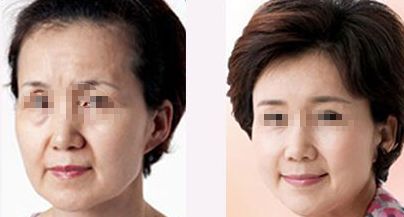 激光祛眼袋的效果及安全性研究