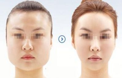 施爾美上瞼松弛矯正：修正眉形，讓你擁有迷人雙眼！