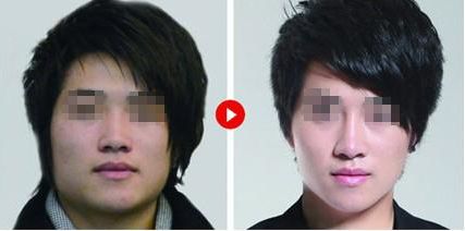 隆鼻修復(fù)，如何科學(xué)達(dá)到理想效果？