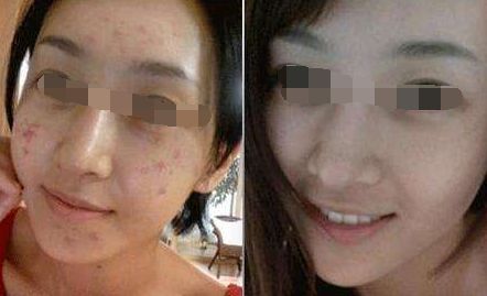 腿部吸脂術(shù)后出現(xiàn)腳腫現(xiàn)象，如何緩解？