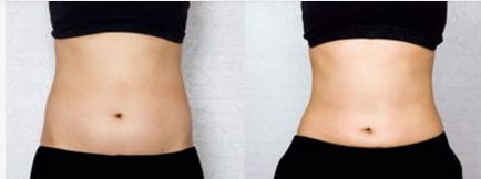 時尚達人必選！令人年輕的電波拉皮術，輕松消除皺紋