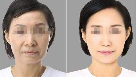 消除眼袋黑眼圈的實用方法及注射透明質(zhì)酸恢復時間