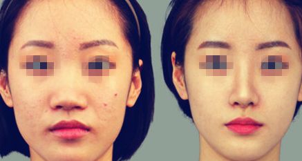 打造精致臉龐 這種法術(shù)你值得擁有！探討瘦臉注射去皺費(fèi)用