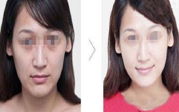 耳廓再造術后洗澡安全細解