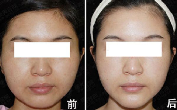 隆鼻手術(shù)后的療程和恢復(fù)時(shí)間