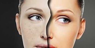 臉部除皺的原理解析，持續(xù)時(shí)間如何