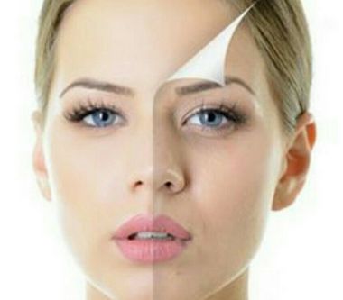 激光祛黃褐斑，美容增形象！潔凈面容的魅力無(wú)限！