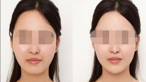 雙眼皮修復(fù)的方法有哪些？解析雙眼皮修復(fù)技術(shù)簡介