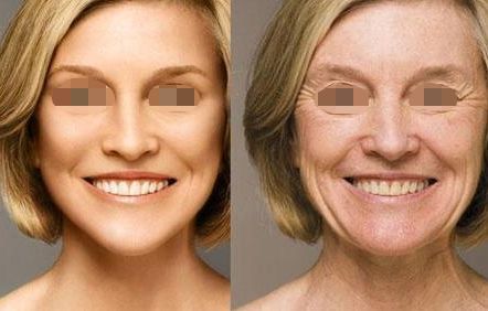 雙眼皮修復(fù)手術(shù)成果展示，煥發(fā)雙眸魅力