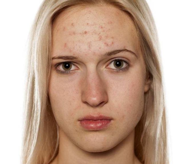 避免隆鼻手術(shù)后遺憾，關(guān)注這些小技巧！