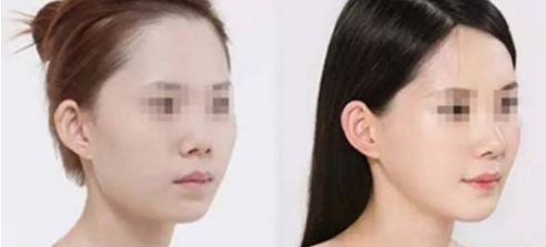假體隆鼻手術(shù)帶來正自然效果，狀似真實(shí)鼻形