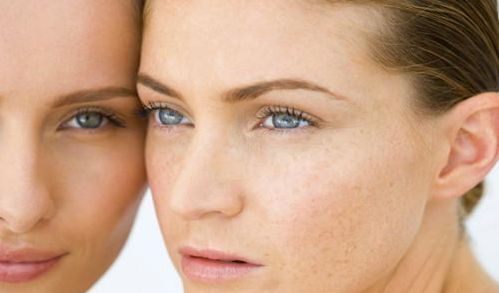 光子嫩膚可以有效去除面部紅血絲，不會引發(fā)結(jié)痂！價位合適，效果明顯