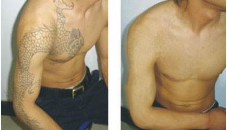 耳軟骨隆鼻術后的疼痛時長與恢復速度！