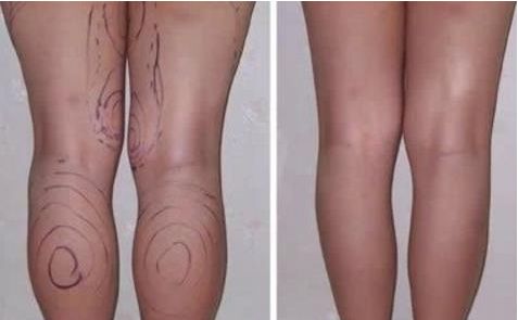 透明質(zhì)酸隆鼻的多重好處，擁有完美鼻部塑造效果