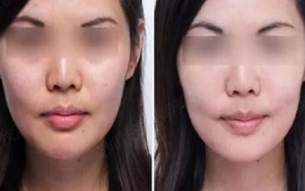 35歲采用超聲療程好還是熱瑪吉更好？匿名評(píng)測(cè)揭秘！