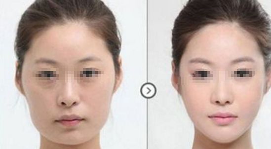 皮膚松弛，如何選擇適合的醫(yī)美項目？熱門方式如熱瑪吉、拉皮等對比解析！