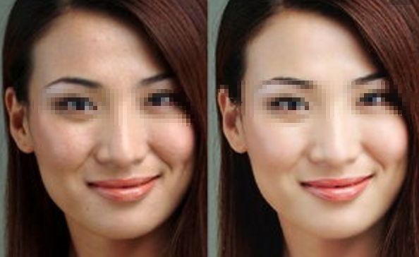 塑料手術鼻子整形價格參考