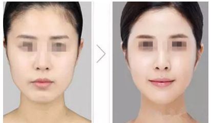 陰道緊縮術(shù)是否痛苦，了解手術(shù)前后的疼痛情況