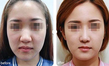 個性化整容美容的熱門技術(shù)及持久時間