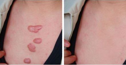 美腿塑造：疤痕會(huì)影響自體脂肪豐臀效果嗎？