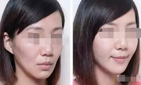 鼻骨矯正術(shù)后護(hù)理小貼士