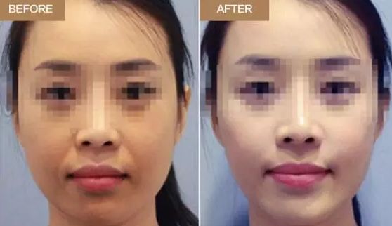 武漢注射法隆鼻價(jià)格、適宜人群都想知道