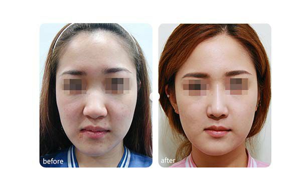 下頜角重塑：手術(shù)前后需要注意的事項(xiàng)