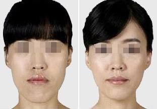 肋骨隆鼻后的面部消腫需要多長(zhǎng)時(shí)間？消腫小竅門(mén)曝光！