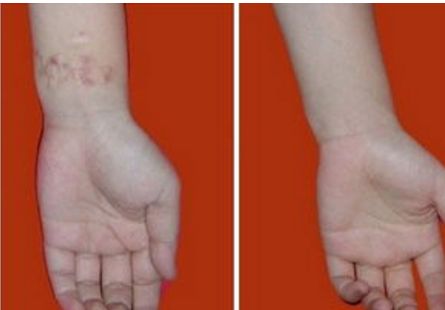 下頜角手術(shù)后遺癥：引發(fā)因素及處理方法解析