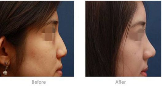 整形手術(shù)費(fèi)用和項(xiàng)目詳解，帶你了解價(jià)格和項(xiàng)目?jī)?nèi)容