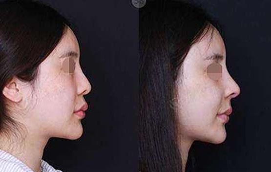 醫(yī)學(xué)美容，提升面部輪廓選什么材料效果好？持久效果如何？