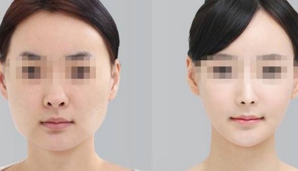 去眼袋手術(shù)后，會(huì)有疤痕嗎？術(shù)后眼部腫脹情況探析