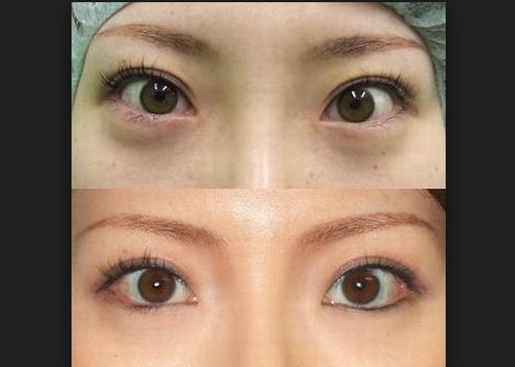 術(shù)后如何正確護理假體豐胸，讓你更安心！