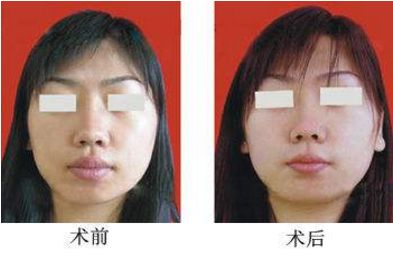 隆鼻手術(shù)費(fèi)用及失敗原因，臨床體征全解析